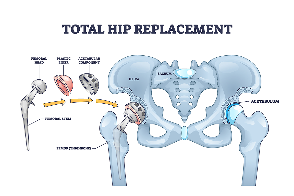 A Guide to Physiotherapy After Hip Replacement Surgery Beverly