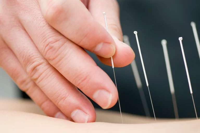 Close-up of a hand carefully inserting thin acupuncture needles into the skin during a therapeutic treatment session.